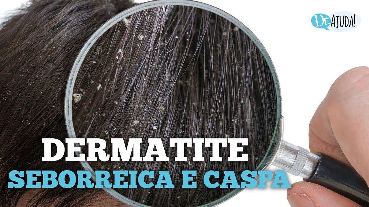 Dermatite seborreica: Quais são as causas? O que fazer?