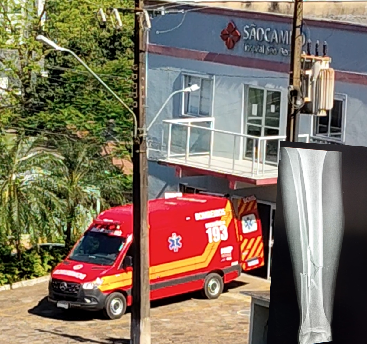 Jovem de 19 anos sofre fratura em uma das pernas em acidente de trabalho no interior de Quilombo